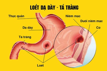 Những bài thuốc dân gian chữa loét dạ dày và tá tràng hiệu quả nhất
